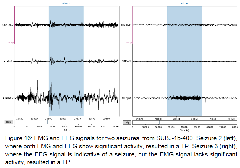 Multimodal signals during seizure events